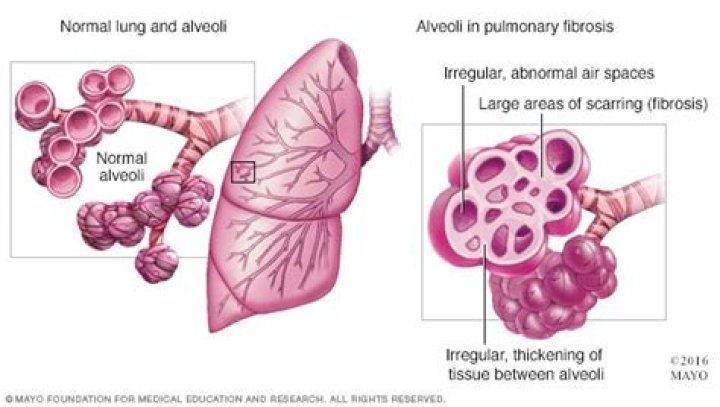 How do you get pulmonary fibrosis?
