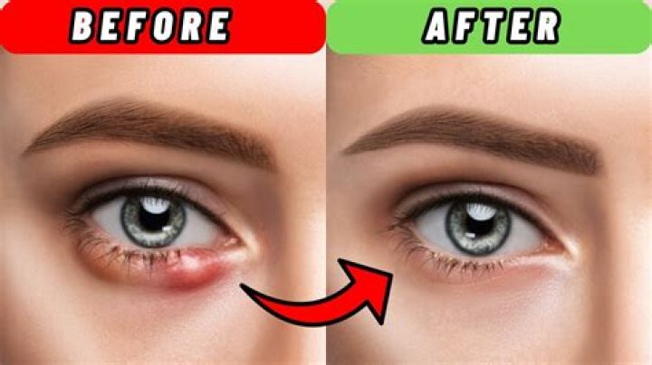 How do you get rid of a blind pimple overnight?