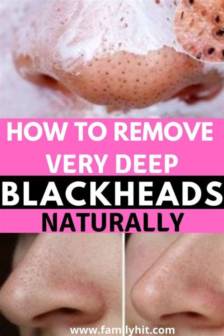 How do you get rid of deep blackheads naturally?
