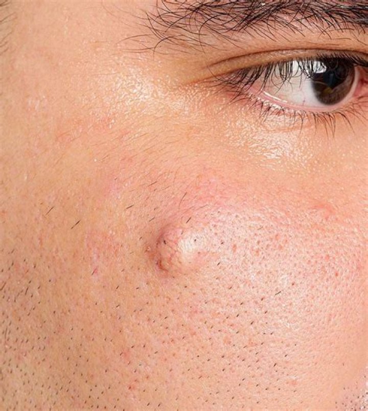 How do you get rid of fatty lumps under the skin?