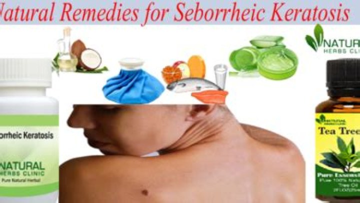 How do you get rid of seborrheic keratosis?