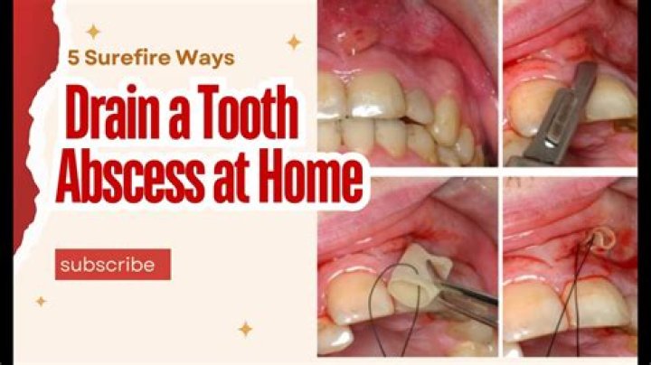 How do you know if a tooth abscess is draining?