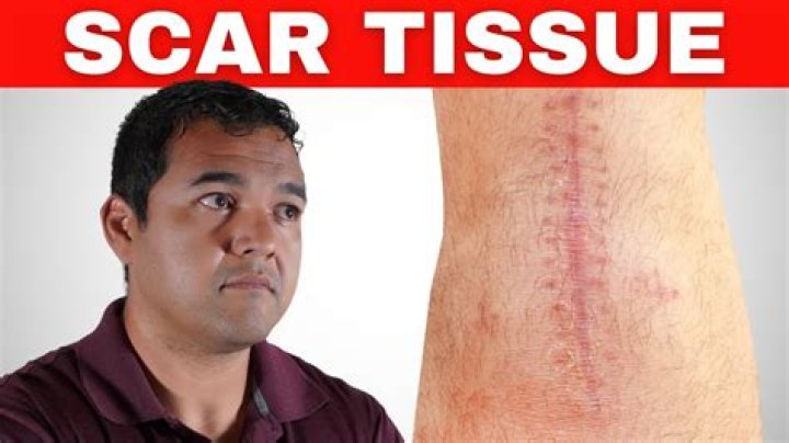 How do you know if you have scar tissue?