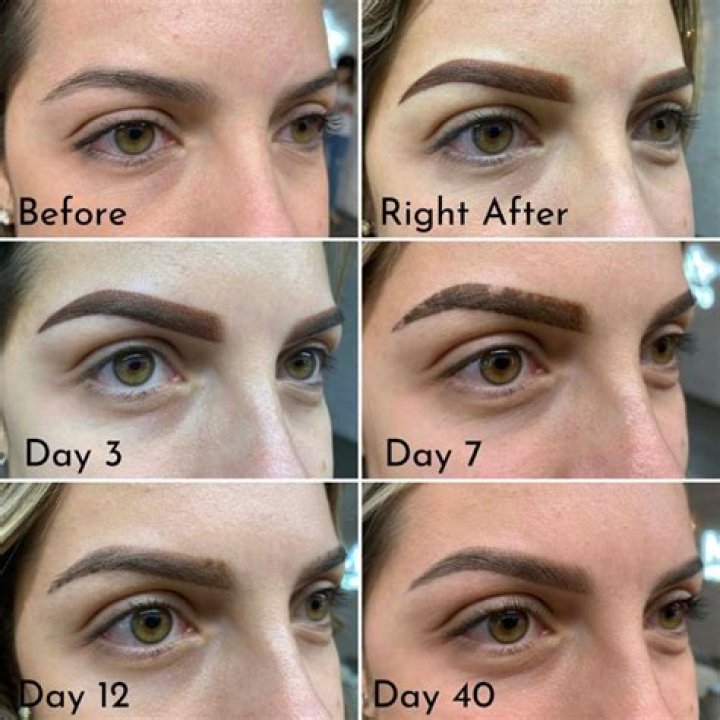 How do you remove microblading after 2 years?