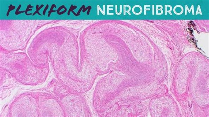 How do you shrink neurofibroma?