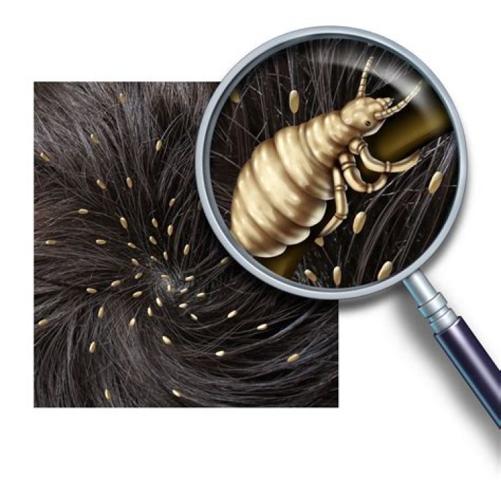 How do you suffocate lice?