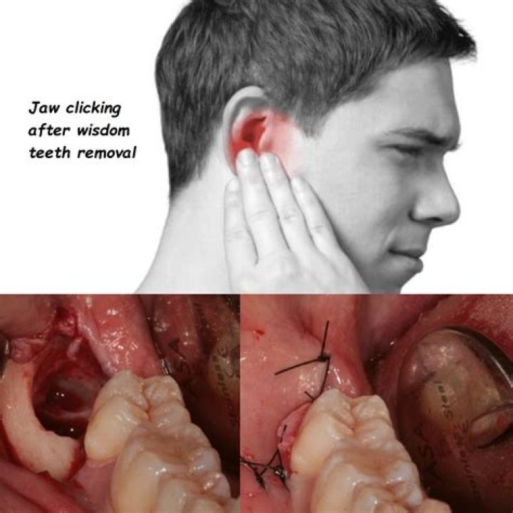 How do you treat holes in wisdom teeth?