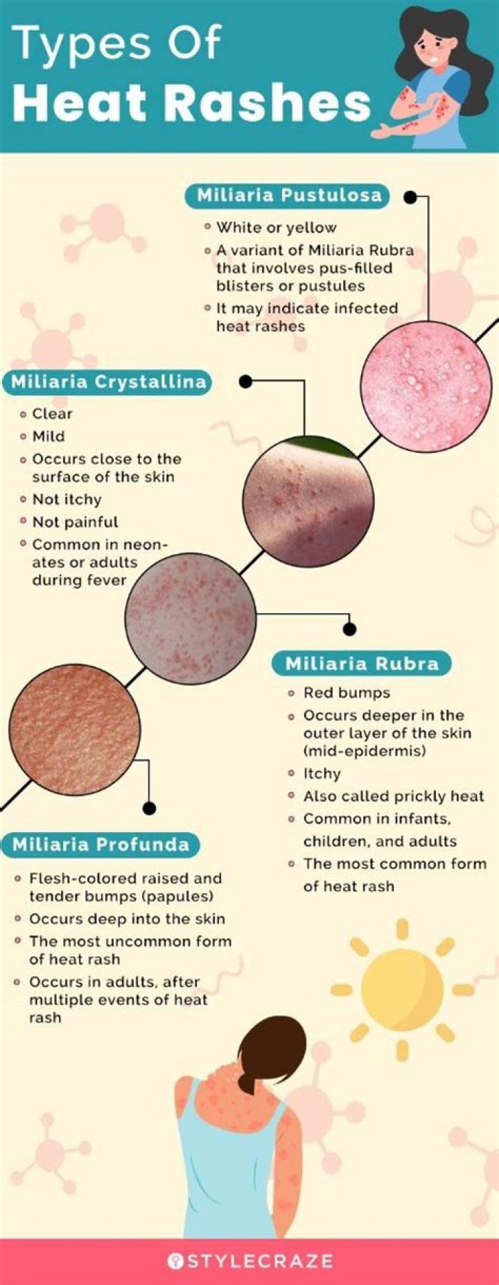 How does heat rash look?
