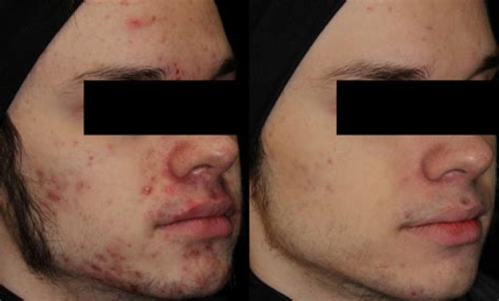 How does Jungkook get rid of acne?