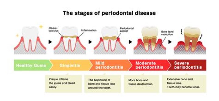 How does periodontal disease affect the body?