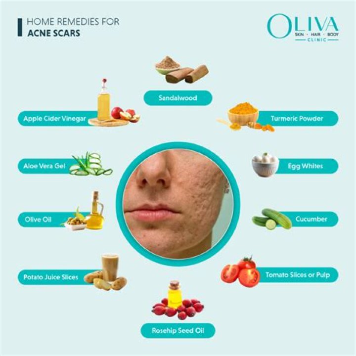 How fast can acne clear up?
