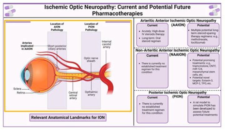 How fast do steroids work for optic neuritis?