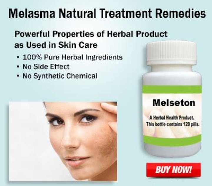 How I cured my melasma naturally?