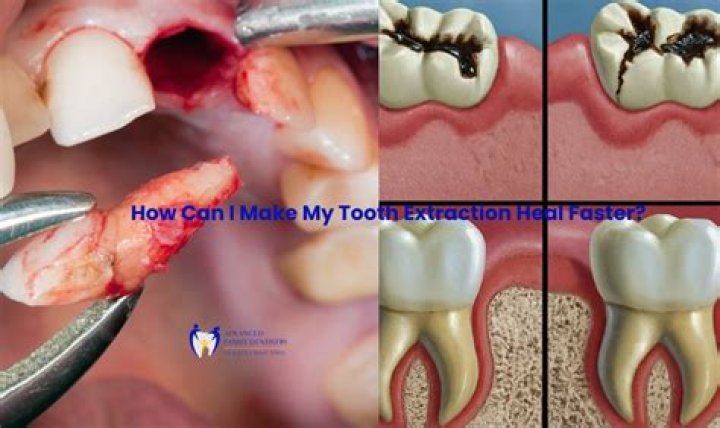 How long after tooth extraction can I brush my teeth?