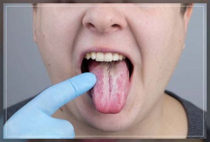 How long can oral thrush last?