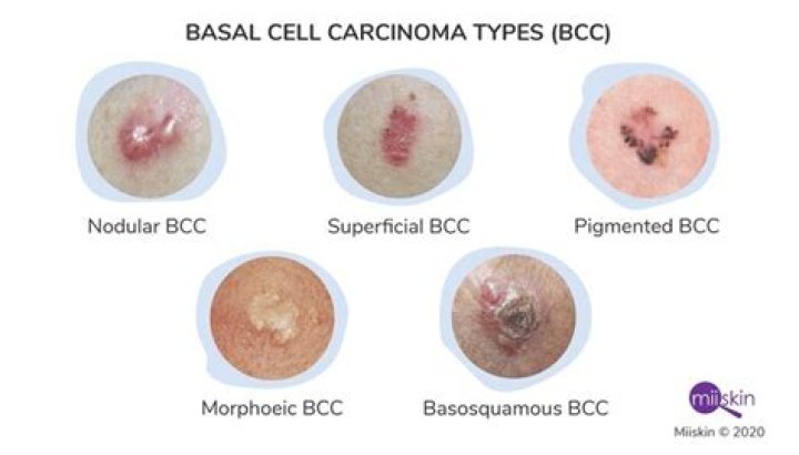 How long can you leave basal cell carcinoma untreated?