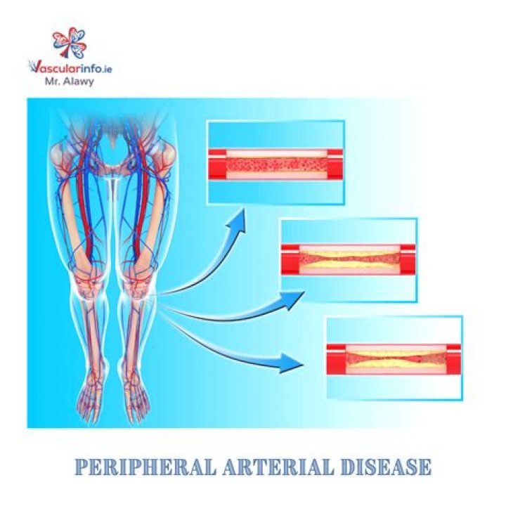 How long can you live with peripheral vascular disease?