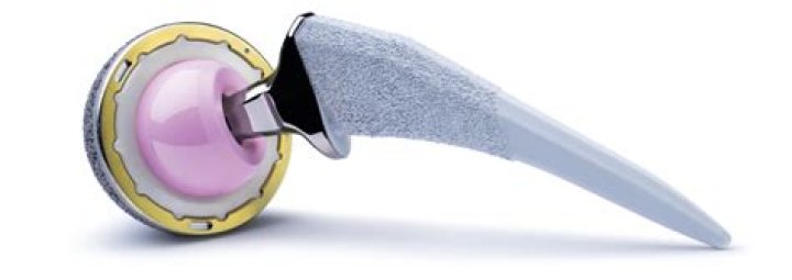 How long do ceramic hip implants last?