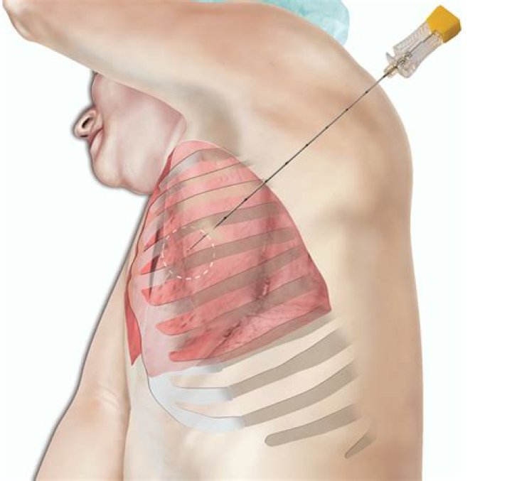 How long do lung biopsy results take?