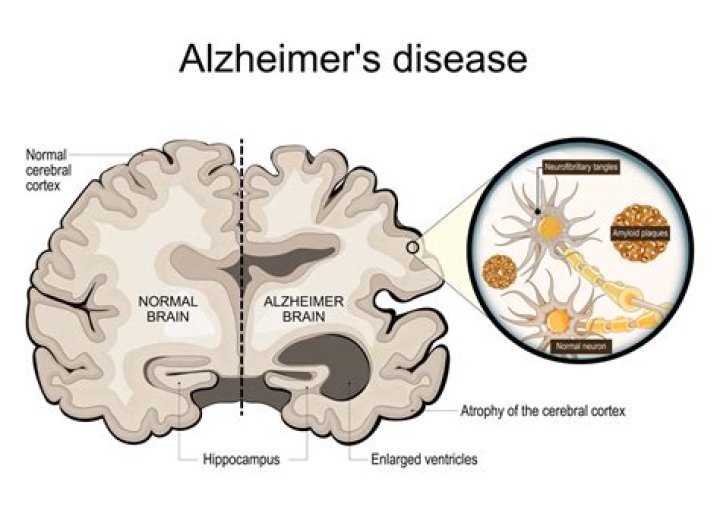 How long do people with Alzheimer's live?