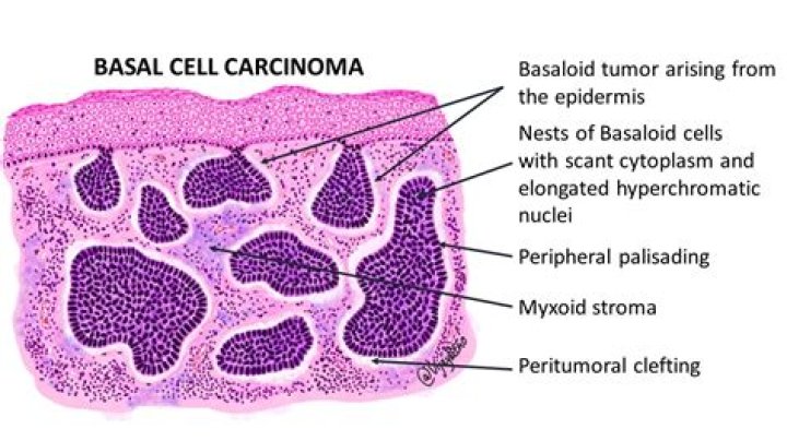 How long does basal cell carcinoma take to spread?