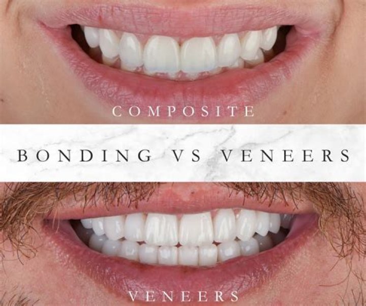 How long does composite bonding last on front teeth?