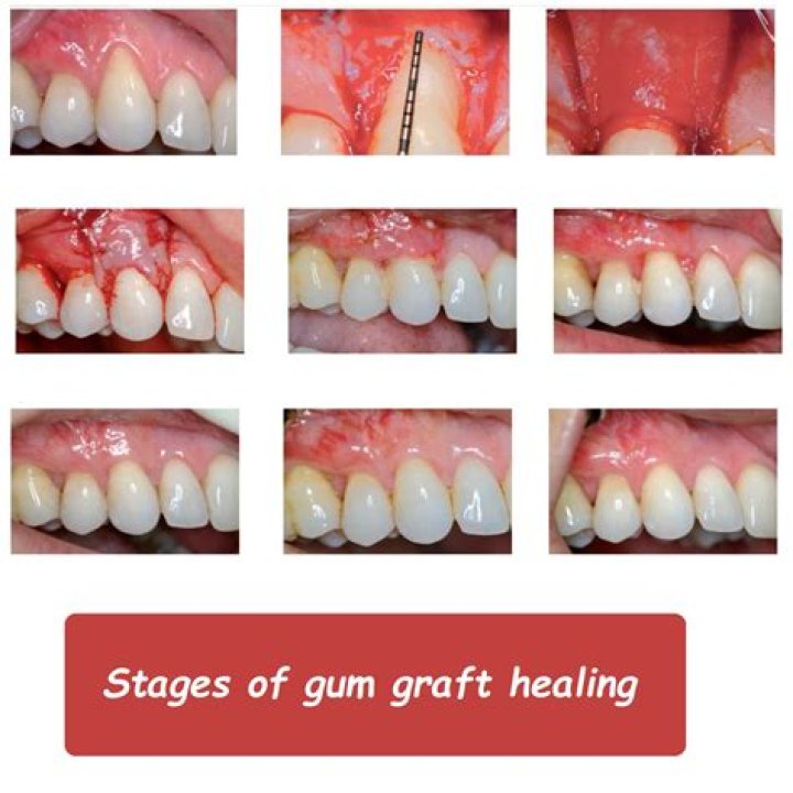 How long does gum graft pain last?