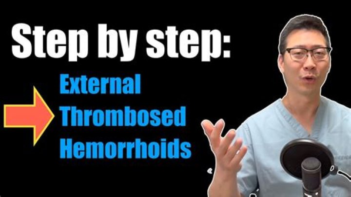 How long does it take for a thrombosed hemorrhoid to resolve?