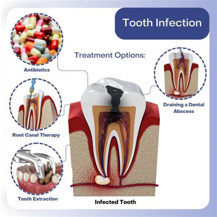 How long does it take for antibiotics to work for a tooth infection?