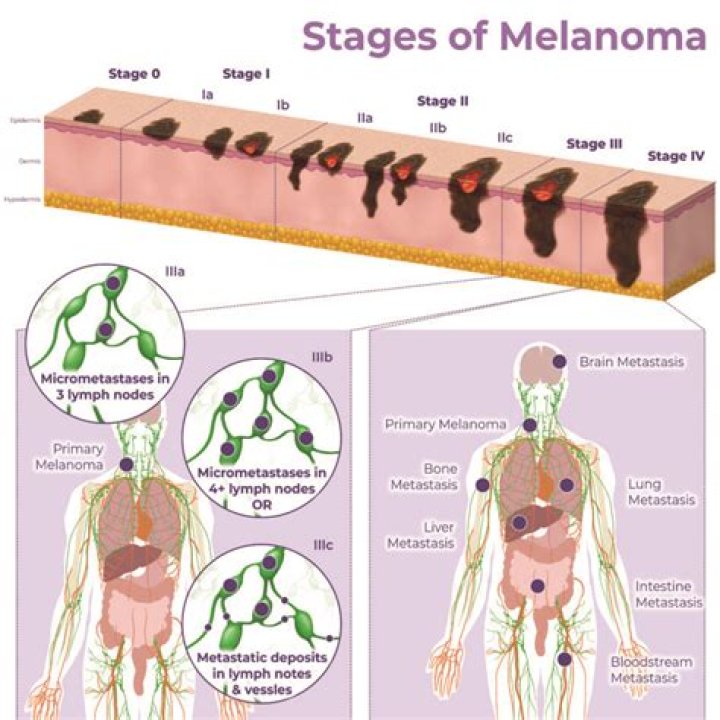How long does it take for melanoma to spread to organs?