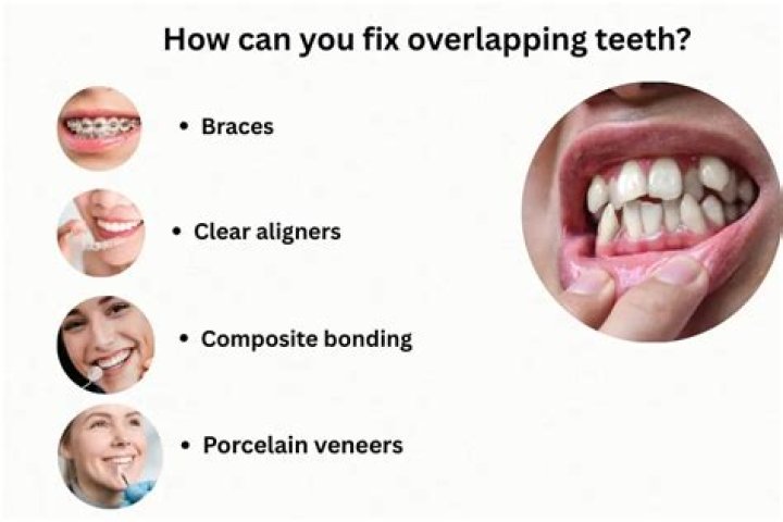 How long does it take to fix overlapping teeth?