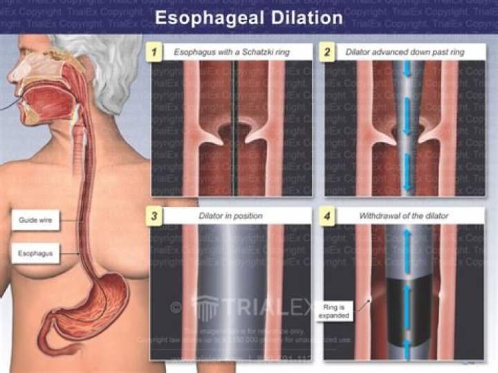 How long does it take to recover from esophageal dilation?