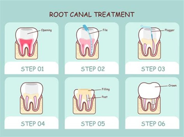 How long is root canal recovery?