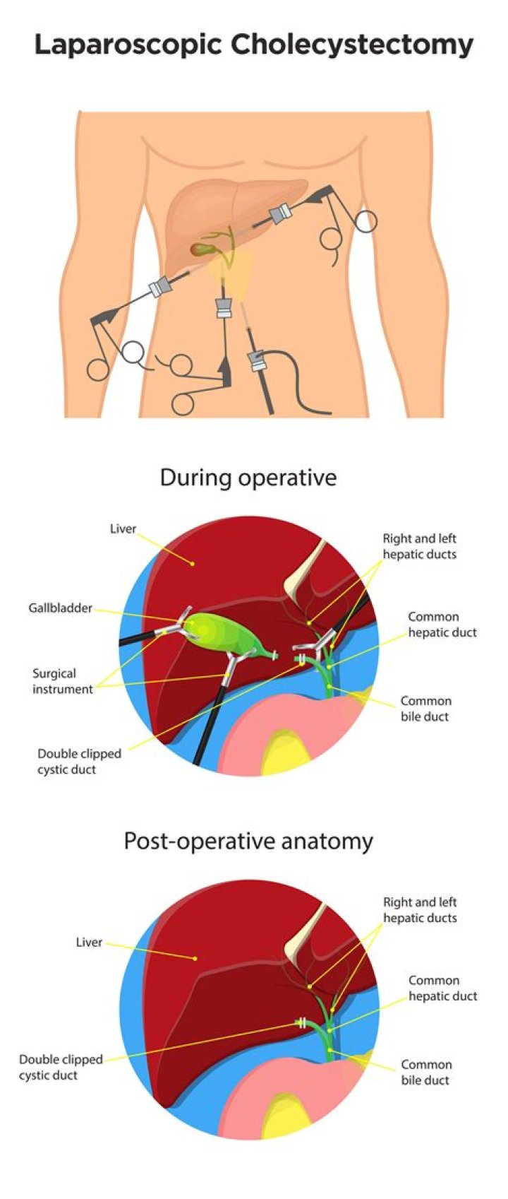 How long is stomach swollen after laparoscopy?