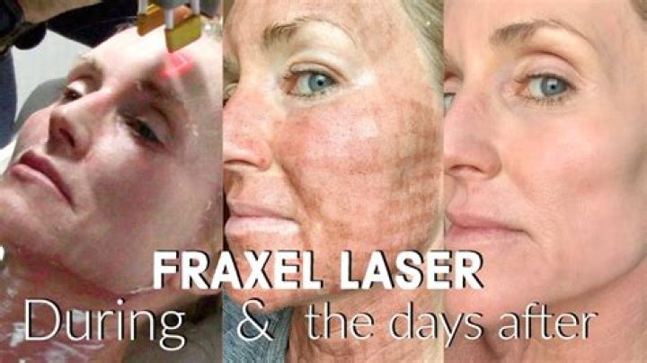 How long should you wait between Fraxel treatments?