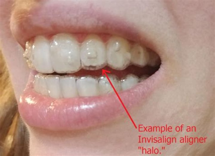 How long will my Invisalign hurt?