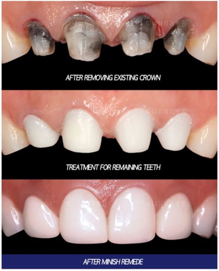 How many times can a tooth be crowned?