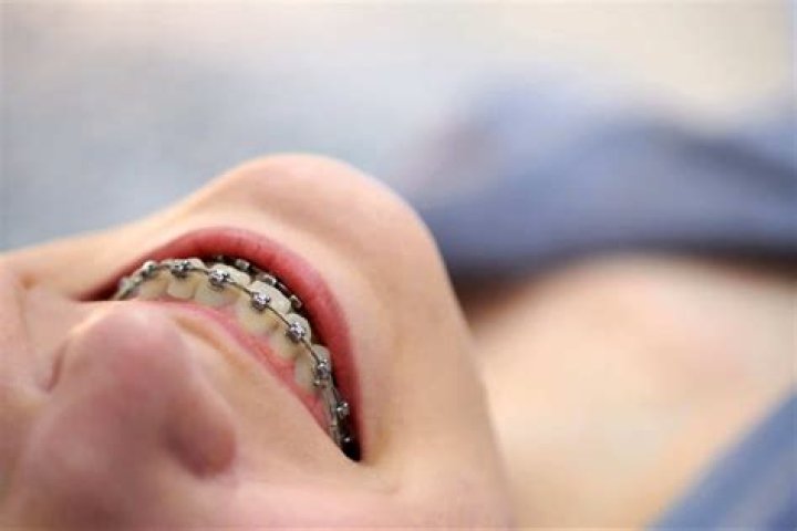 How often do braces get tightened?