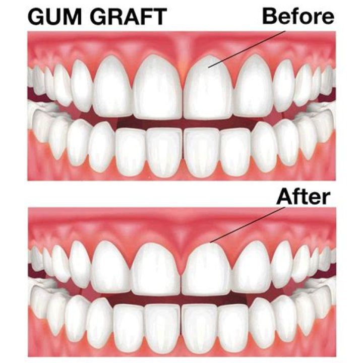 How painful is gum graft surgery?