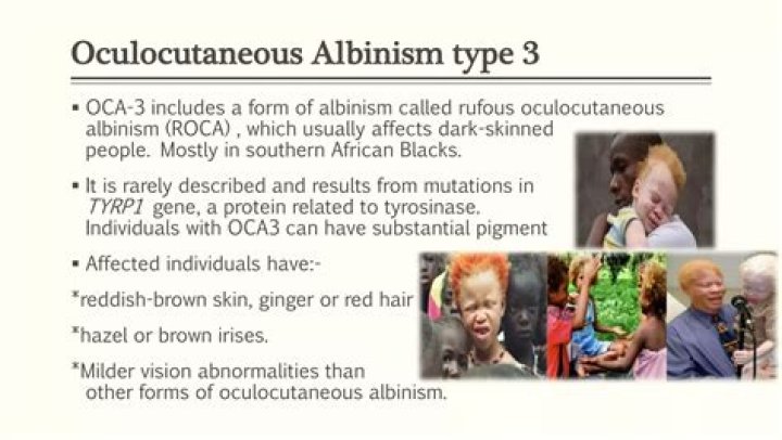 How rare is oculocutaneous albinism?