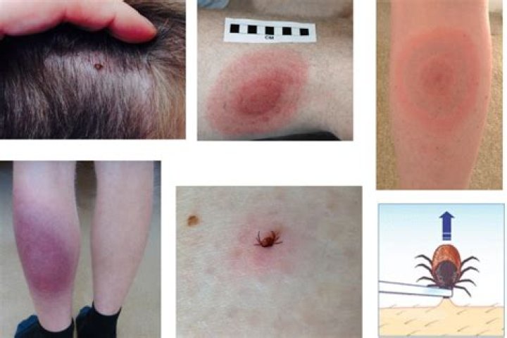 How serious is Lyme disease?