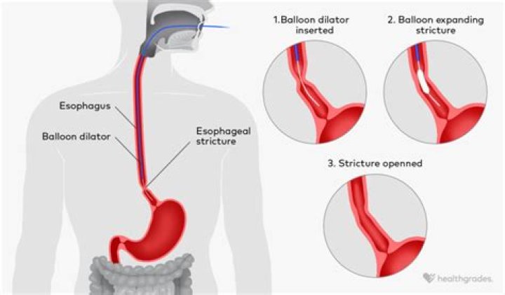 How serious is narrowing of the esophagus?