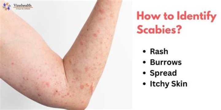 How serious is scabies?