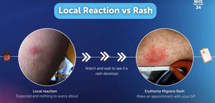 How would you treat a large local reaction to a wasp sting?