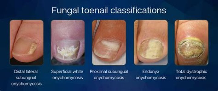 Is a toe fungus contagious?