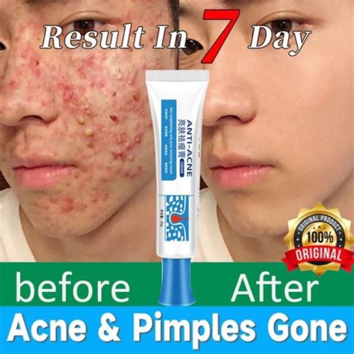 Is acne Clear good for pimples?