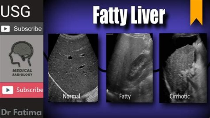 Is an enlarged liver the same as a fatty liver?