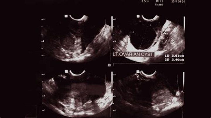 Is Apple good for ovarian cyst?