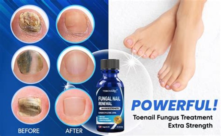 Is baking soda good for toe fungus?