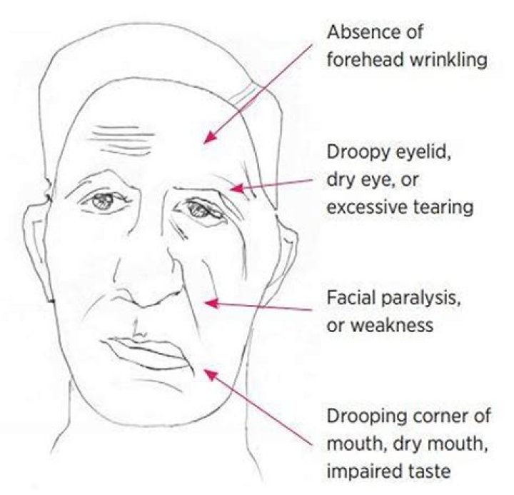 Is Bell's palsy painful?